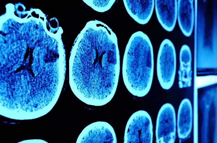 درمان تومور مغری در نوجوان 13 ساله