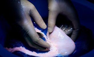 دومین پیوند کلیه خوک