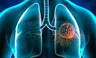 سرطان در افراد مسن