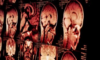 ضربه مغزی در مردان