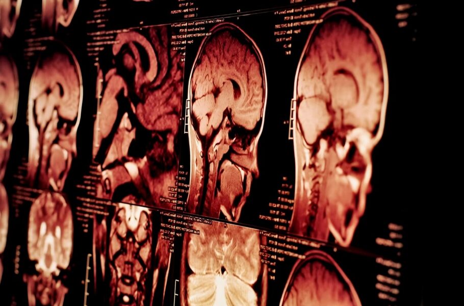 ضربه مغزی در مردان